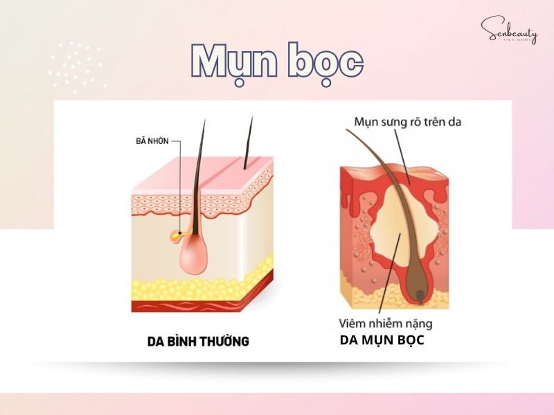 Mụn bọc