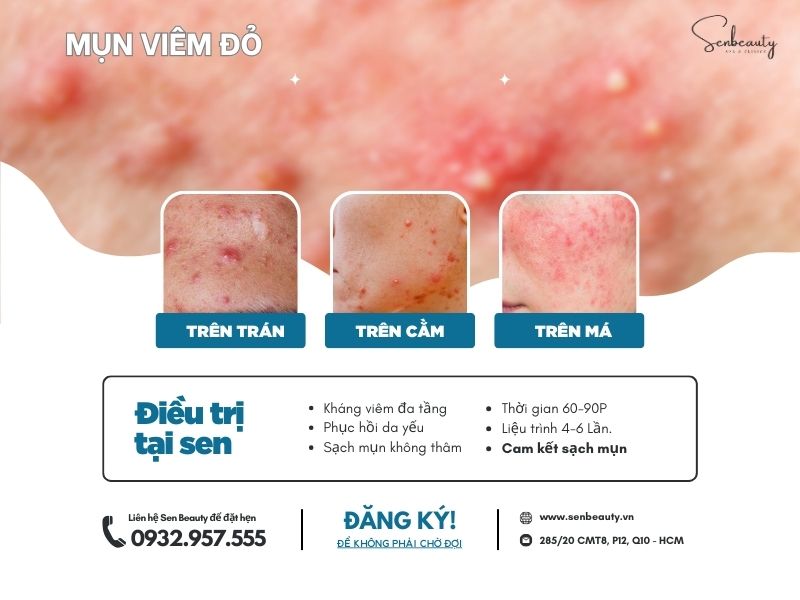 Điều trị mụn viêm đỏ