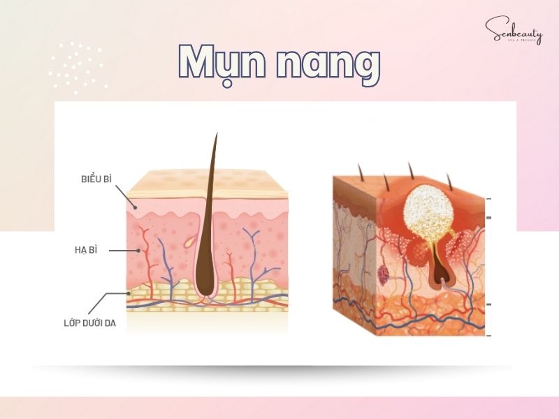 Mụn nang