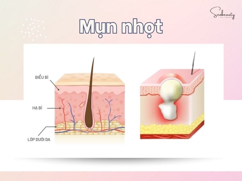Mụn nhọt