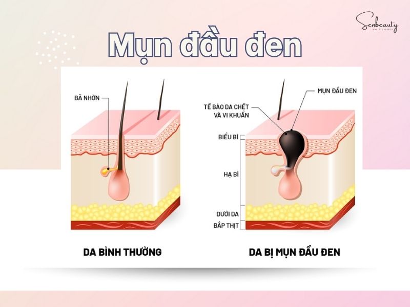 Mụn đầu đen là một loại mụn không viêm thường xuất hiện trên da khi lỗ chân lông bị tắc nghẽn do sự tích tụ của dầu (bã nhờn), tế bào chết và bụi bẩn.
