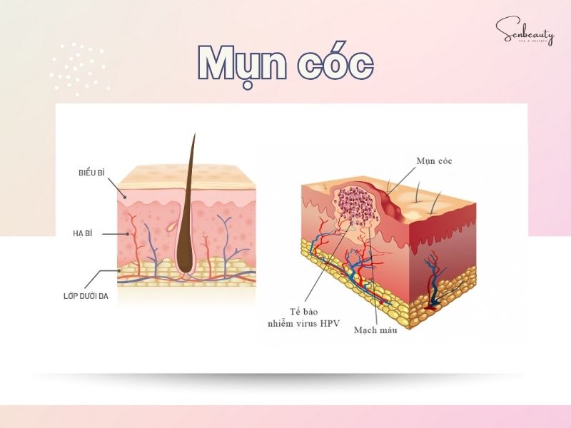Mụn cóc