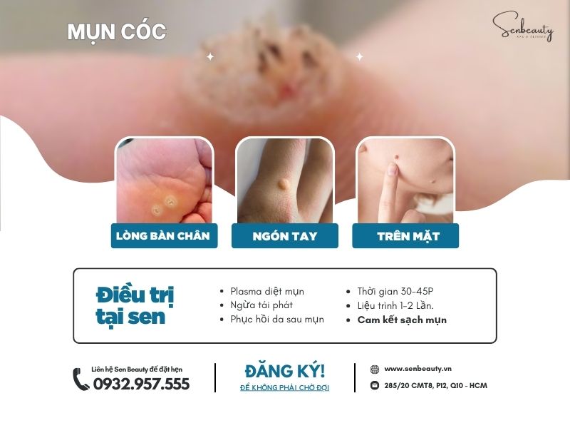 Điều trị mụn cóc