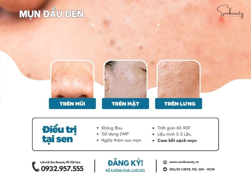 Trị mụn đầu đen