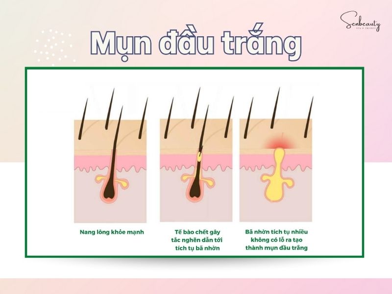 Mụn đầu trắng