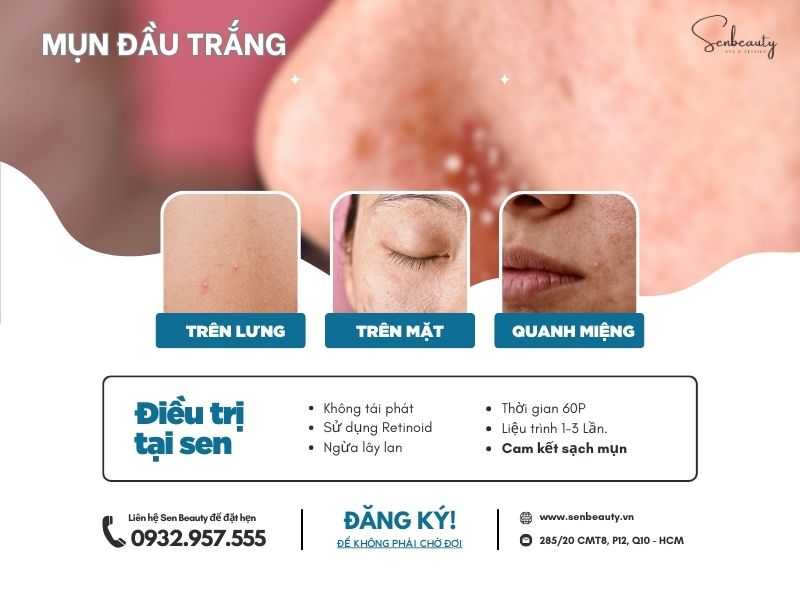 Trị mụn đầu trắng tại Sen beauty