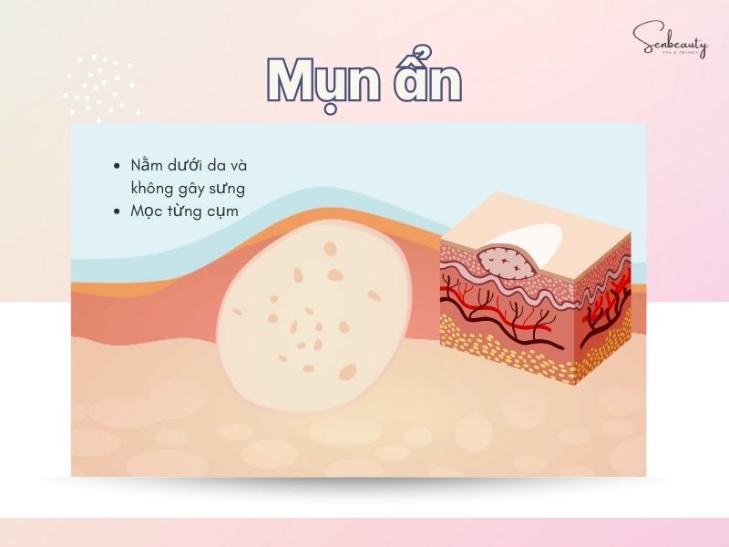 Mụn ẩn