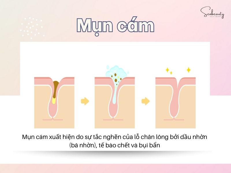 Mụn cám