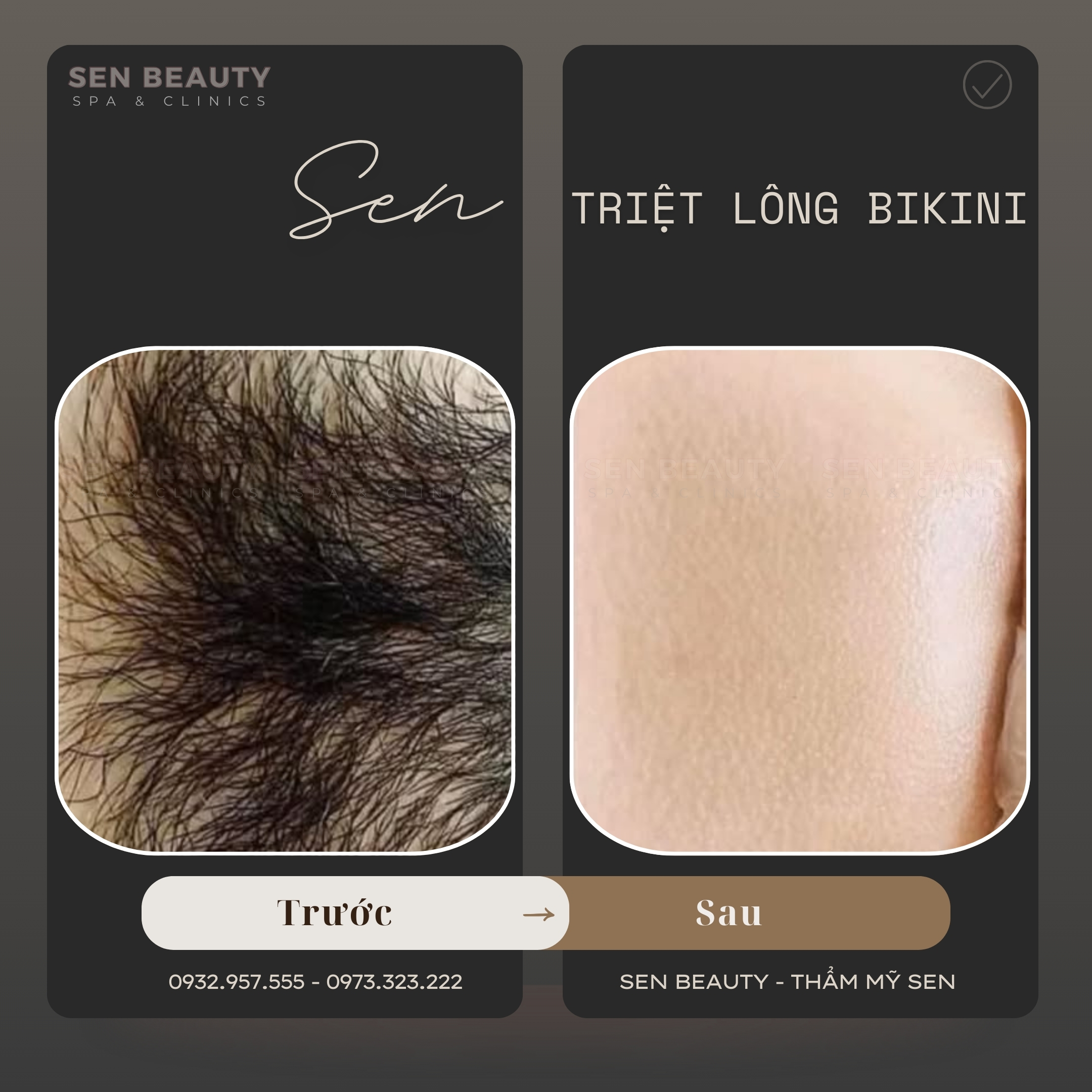 Triệt hiệu quả hỗ trợ sáng da vùng bikini sau liệu trình.