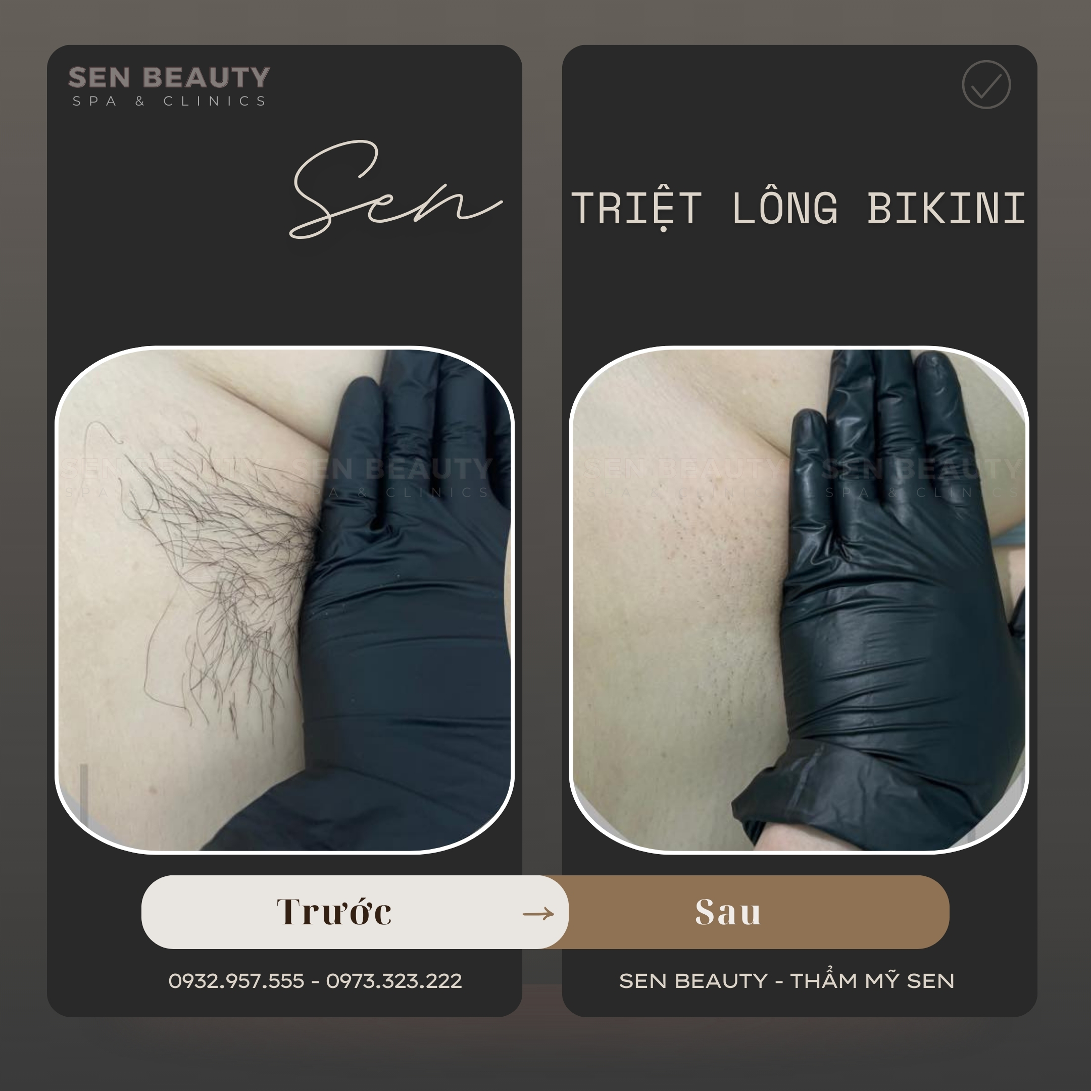 Kết quả triệt bikini diode tại Sen